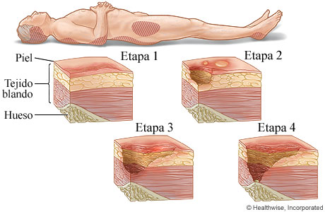 Las cuatro etapas de las lesiones por presión.