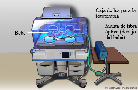 Bebé recibiendo fototerapia para la ictericia