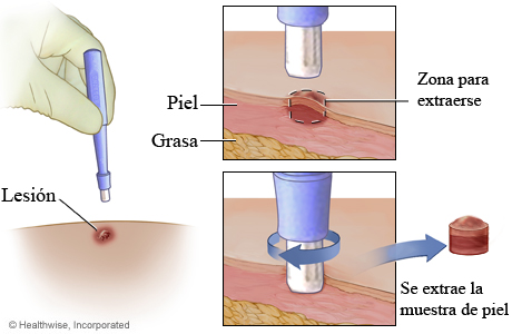 Biopsia en sacabocados