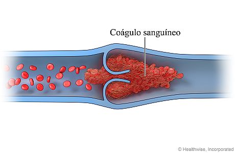 Corte transversal de una vena que muestra un coágulo de sangre que se ha formado alrededor de la válvula