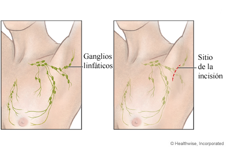 Sitio de una biopsia abierta de los ganglios linfáticos