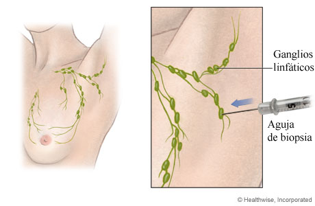 Biopsia de los ganglios linfáticos con aguja fina