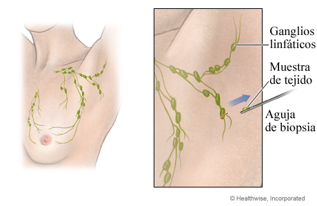 Biopsia de los ganglios linfáticos con aguja gruesa