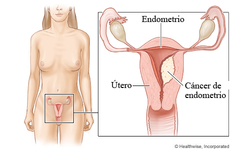 Cáncer de endometrio