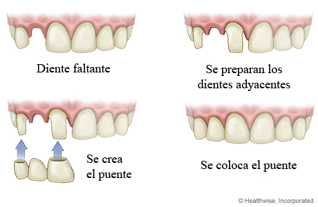 Cómo se coloca un puente para un diente faltante