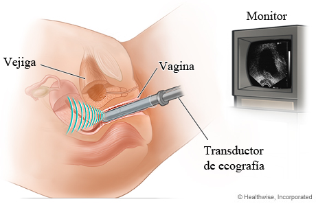 Ecografía transvaginal