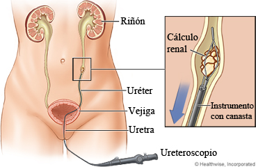 Litotricia por láser