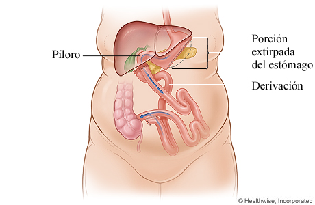 Derivación biliopancreática con cruce duodenal