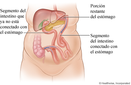 Derivación biliopancreática