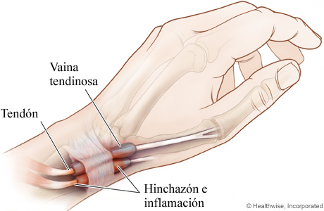 Tendón afectado por la tenosinovitis de De Quervain