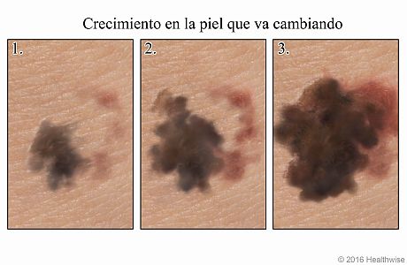 Tres imágenes que muestran un crecimiento en la piel que se agranda con el tiempo