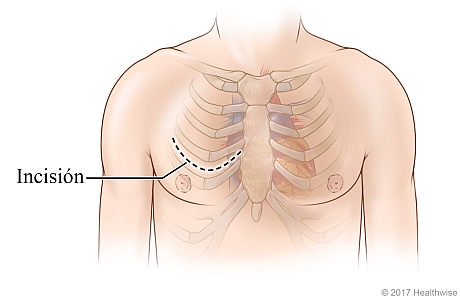 Lugar de la incisión en el tórax (pecho) entre dos costillas