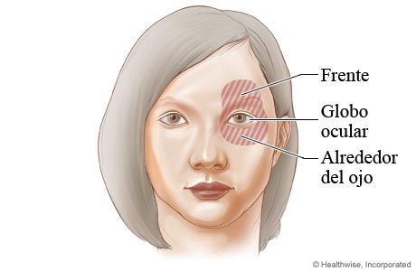 Imagen de las áreas de dolor debido al glaucoma de ángulo cerrado