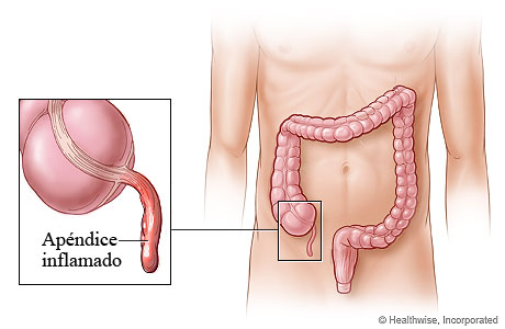 Apendicitis y ubicación del apéndice en el cuerpo