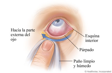 Cómo limpiar un ojo