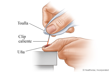 Cómo drenar sangre de debajo una uña