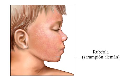 Salpullido de rubéola (sarampión alemán)