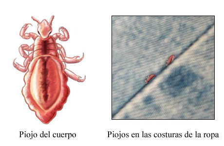 Piojos del cuerpo