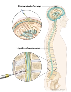 Quimioterapia intratecal; la imagen muestra el líquido cefalorraquídeo (LCR) en el cerebro y la médula espinal, y un reservorio (depósito) de Ommaya (un aparato en forma de cúpula que se coloca debajo del cuero cabelludo mediante cirugía; este contiene los medicamentos que circulan por un tubo delgado hasta el cerebro). En la sección superior se muestra una jeringa con la que se inyectan medicamentos contra el cáncer en el reservorio de Ommaya. En la sección inferior se muestra una jeringa con la que se inyectan medicamentos contra el cáncer directamente en el LCR en la parte inferior de la columna vertebral.