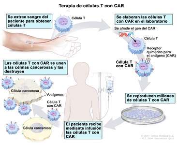 Terapia de células T con CAR; en el dibujo se muestra que se extrae sangre de una vena del brazo de un paciente para obtener células T. También se muestra que se prepara en el laboratorio un receptor especial, que se llama receptor de antígeno quimérico (CAR); se inserta el gen que produce el CAR en las células T y luego se reproducen millones de células T con CAR. Además, se muestra que el paciente recibe las células T con CAR por infusión, y que luego estas células se unen a los antígenos de las células cancerosas y las destruyen.