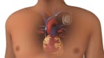 Arritmia: ¿Qué es un desfibrilador cardioversor implantable? (subtitulado)