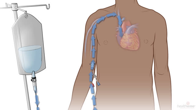 Tratamiento por medio de un catéter PICC o una vía central