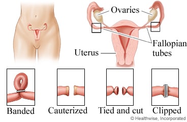 Tubal ligation methods for sterilization.