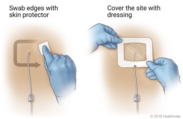 Swabbing the edges of the site with a skin protector and covering the site with a dressing.