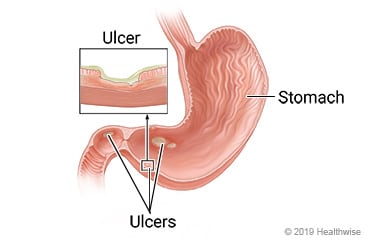 Inside view of a stomach with ulcers, with detail of an ulcer on the stomach wall