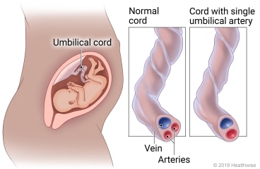 The location of the umbilical cord during pregnancy, with detail of a normal cord versus a cord with a single artery