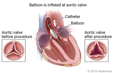 Balloon valvuloplasty, showing location of the balloon in the heart and the difference between the aortic valve before valvuloplasty and after the procedure