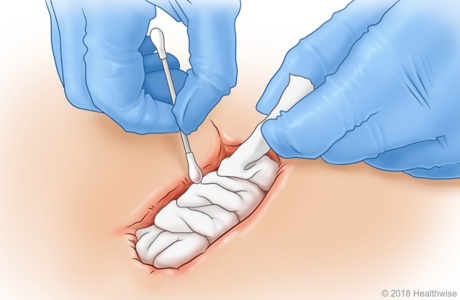 Using fingers and cotton swab to pack gauze into the wound.