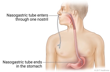 Nasogastric tube enters nostril, passes down through throat, and ends in stomach