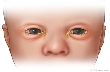 Newborn baby with bacterial conjunctivitis, showing eyes with redness, swelling, and discharge