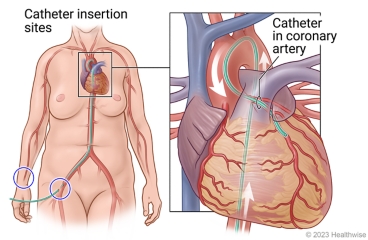 Catheter insertion sites at wrist and groin, showing catheter inserted at groin to heart, with detail of catheter in coronary artery.