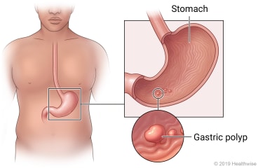 Location of stomach in upper belly, with detail of stomach lining with polyps and close-up of a gastric polyp