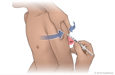 Child getting heparin shot, with skin pinched on back of upper arm and syringe inserted at 45-degree angle