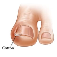 Big toe with ingrown toenail, with cotton wedged under corner of toenail to treat it.