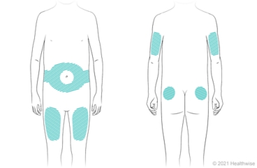 Locations on body for giving insulin shots, including on belly around navel, thighs, back of upper arms, and upper buttocks.