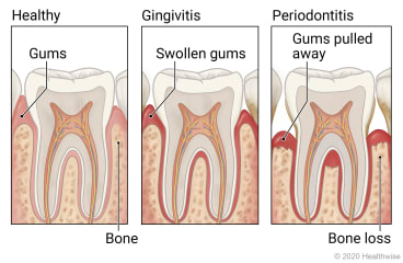 Showing progression of gum disease, with detail of healthy tooth, of gingivitis and swollen gums, and of periodontitis with gums pulled away and bone loss.