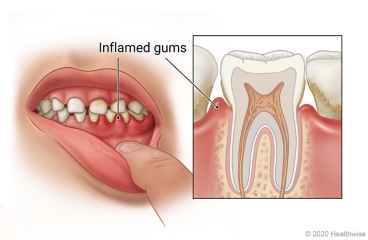 Child's mouth with inflamed gums, with detail showing inside a tooth surrounded by inflamed gums.