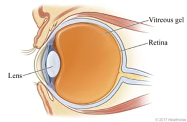 Cross-section of healthy eye, showing the lens, vitreous gel, and retina