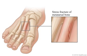 Skeletal view of metatarsal bones of the foot