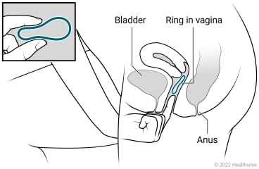 Birth control ring, showing ring being placed in vagina.