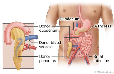 Abdominal organs including duodenum, pancreas, and small intestine, showing transplant of donor duodenum, pancreas, and blood vessels into lower belly.