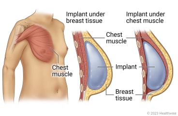 Chest muscle in upper body, with detail showing implant placed between chest muscle and breast tissue and detail showing implant placed under chest muscle.