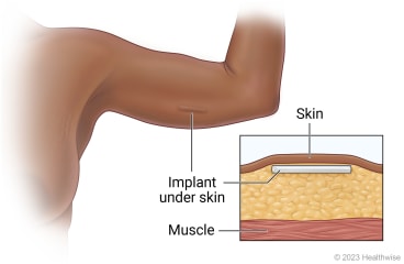 An example of where the birth control implant is inserted in under the skin.