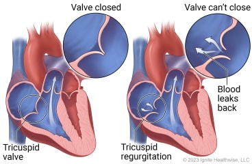 A heart showing the tricuspid valve, with detail of a closed valve, and a heart showing valve that can't close letting blood leak back into atrium.