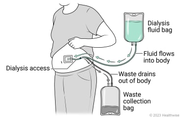 Dialysis fluid flowing from bag through tube into body through dialysis access on belly, and waste draining out of body into waste collection bag.