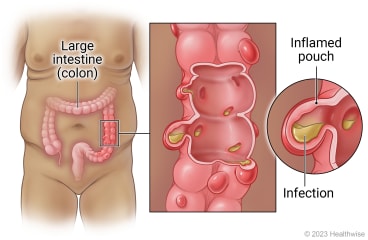 Location of large intestine (colon) in belly with detail of colon section and closeup of inflamed pouches (diverticula).